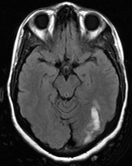  vision. MRI confirmed the presence of a left occipital and temporal